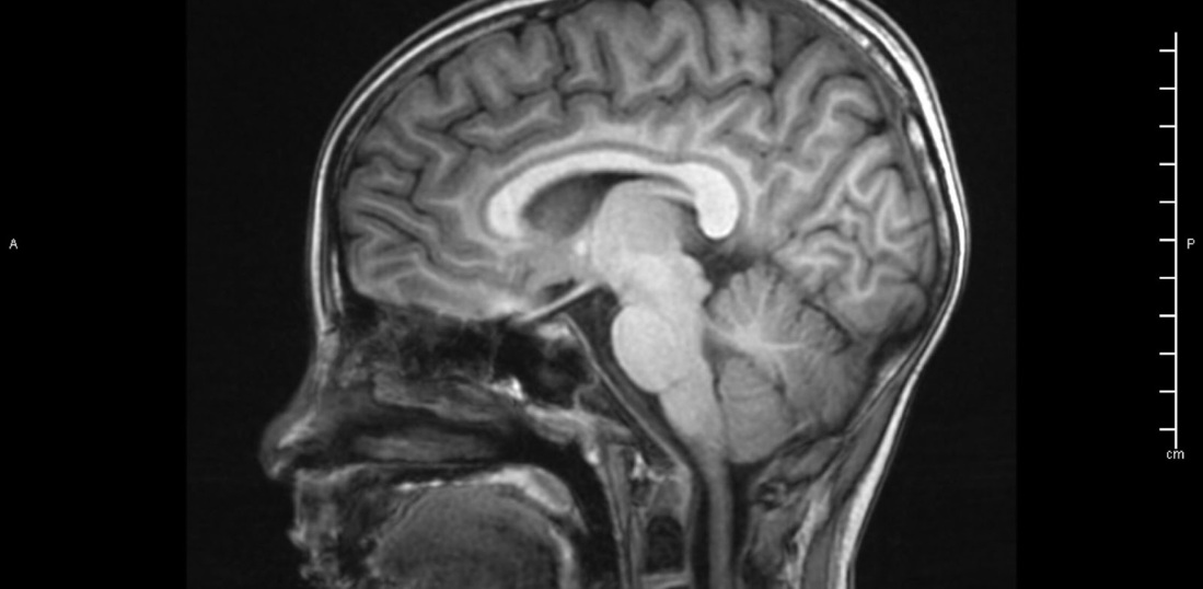Рентгеновский снимок головного мозга
